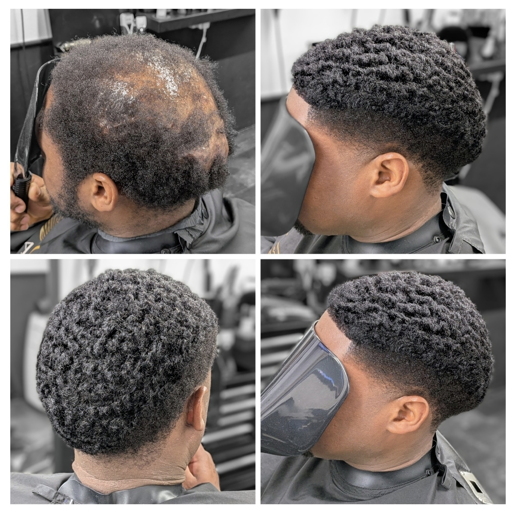 Non Surgical Hair Replacement 